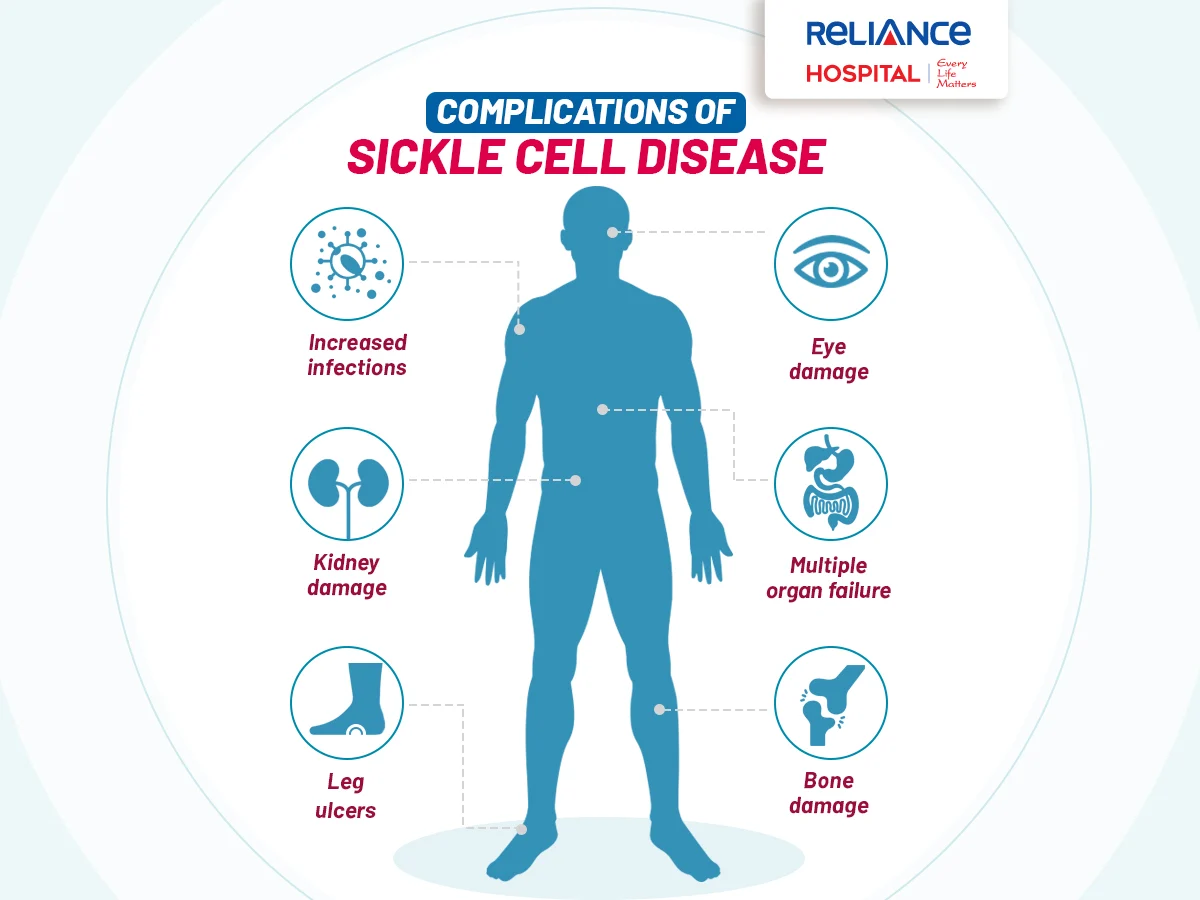 sickle cell