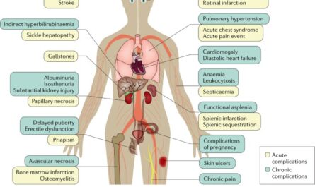 Sickle cell