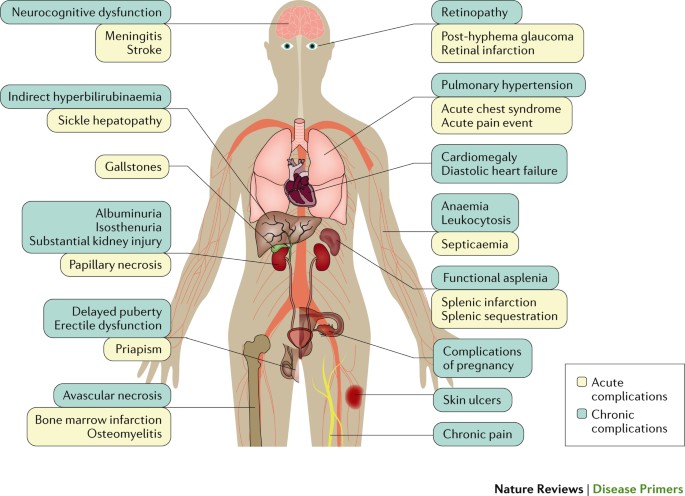 How Sickle Cell Disease Affects Overall Health: Understanding the Impact