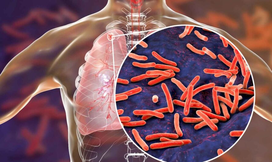 The Importance of Public Health Initiatives in Combating Tuberculosis